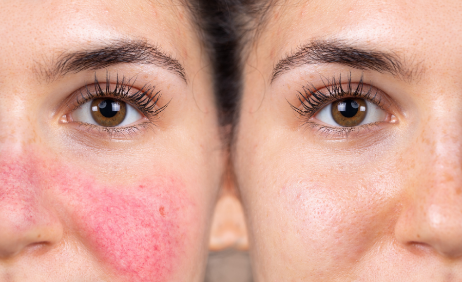 Frequently Asked Questions About Rosacea