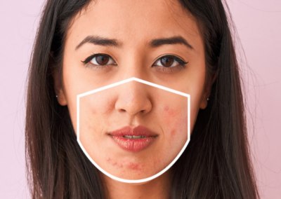 Got ‘Maskne’ (aka acne from wearing a face mask)?