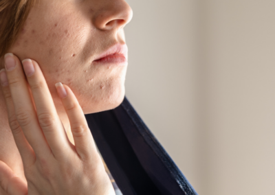 Is Your Mask Causing Acne, Again? (aka ‘Maskne’)