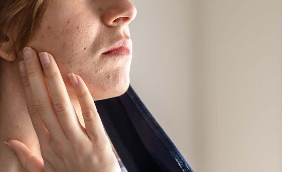 Is Your Mask Causing Acne, Again? (aka ‘Maskne’)