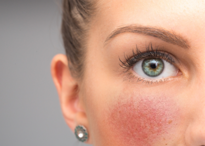 Tips for Managing Rosacea