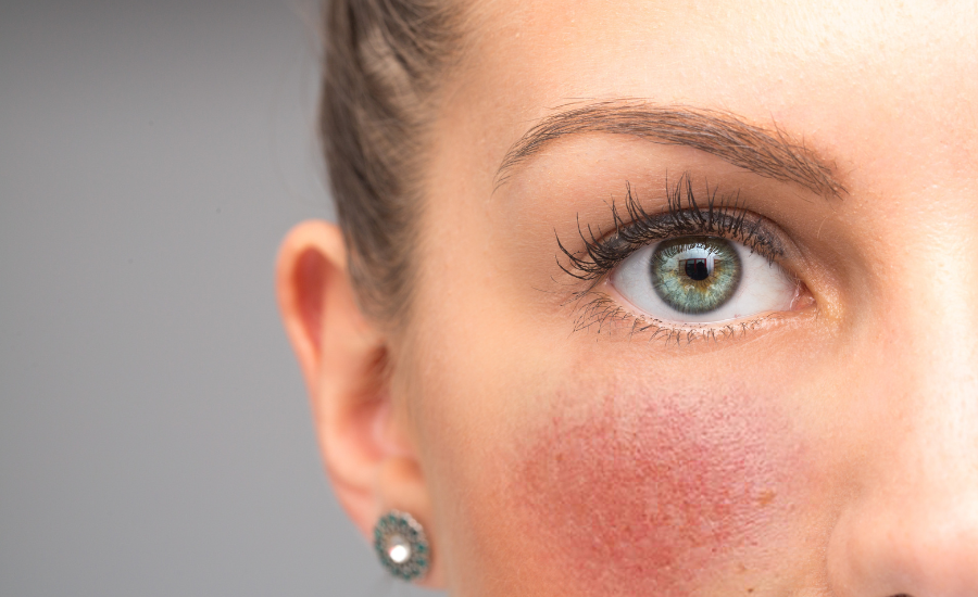 Tips for Managing Rosacea